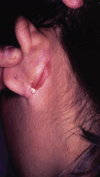 Figura 85. Fisura retroauricular. Figura 85. Fisura retroauricular.