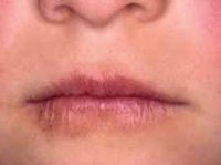 Figura 87. Queilitis en dermatitis atópica. Figura 87. Queilitis en dermatitis atópica.