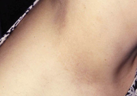 Figura 88. Atrofia epidérmica en cuello por corticoides. Figura 88. Atrofia epidérmica en cuello por corticoides.