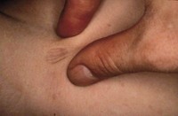 Figura 89. Anetodermia (pérdida de fibras elásticas). Figura 89. Anetodermia (pérdida de fibras elásticas).