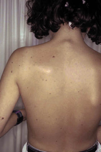 Figura 8. Nevus melanocíticos. Figura 8. Nevus melanocíticos.