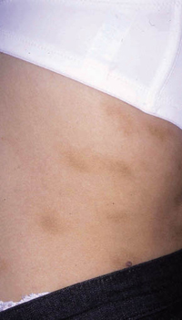 Figura 90. Atrofodermia (toda la dermis). Figura 90. Atrofodermia (toda la dermis).