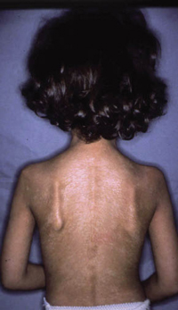 Figura 94. Esclerodermia asociada al síndrome tóxico por aceite de colza adulterado. Figura 94. Esclerodermia asociada al síndrome tóxico por aceite de colza adulterado.