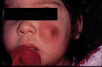 Figura 98. Leishmaniasis (botón de Oriente). Figura 98. Leishmaniasis (botón de Oriente).