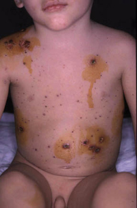 Figura 99. Ulceración de lesiones de varicela por infección secundaria.