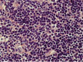 Figura 3. Linfoma linfoblástico células T