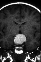 Figura 2. RM, corte coronal: craneofaringioma antes de la extirpación