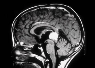 Figura 4. RM, corte axial: tumor pineal antes de la extirpación
