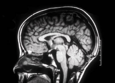 Figura 5. RM, corte axial: tumor pineal después de la extirpación