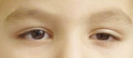 Figura 4. Signo de Claudio Bernard Horne: ptosis, miosis y endoftalmos