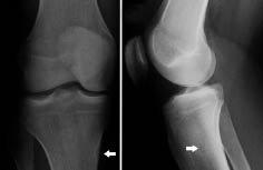Figura 12. Radiografía anteroposterior (A) y lateral (B) de la rodilla derecha