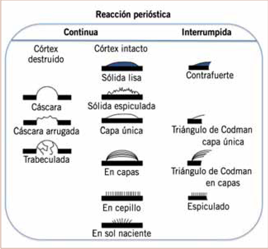 Figura 2. Esquema de los diferentes tipos de reacciones periósticas.