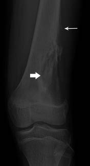 Figura 5. Osteosarcoma en la metáfisis proximal del fémur (flecha gruesa)