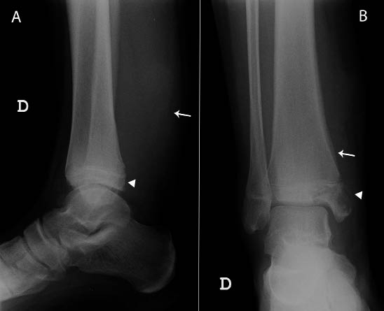 Figura 7. Radiografía lateral (A) y anteroposterior (B) del extremo distal de la pierna derecha