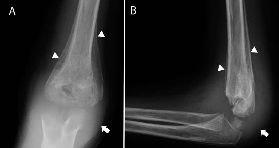 Figura 8. Radiografía anteroposterior (A) y lateral (B) del codo derecho