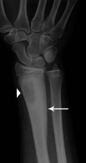 Figura 9. Lesión lítica en la metáfisis distal del radio derecho (punta de flecha) con reacción perióstica en capas (flecha)