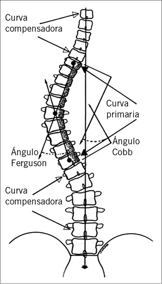 Deformidades de la columna vertebral