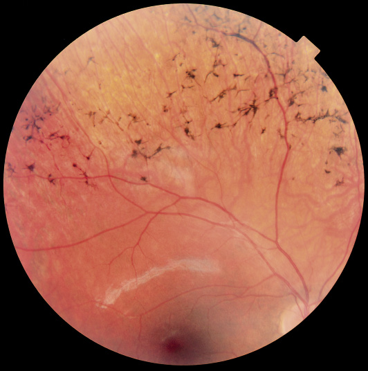 Fondo de ojo | Pediatría integral