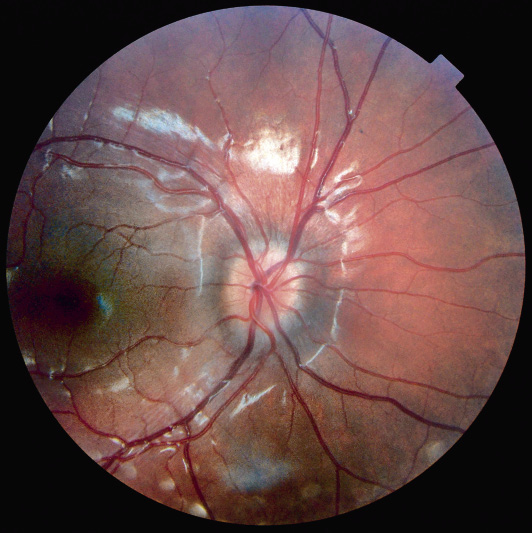 Fondo de ojo | Pediatría integral