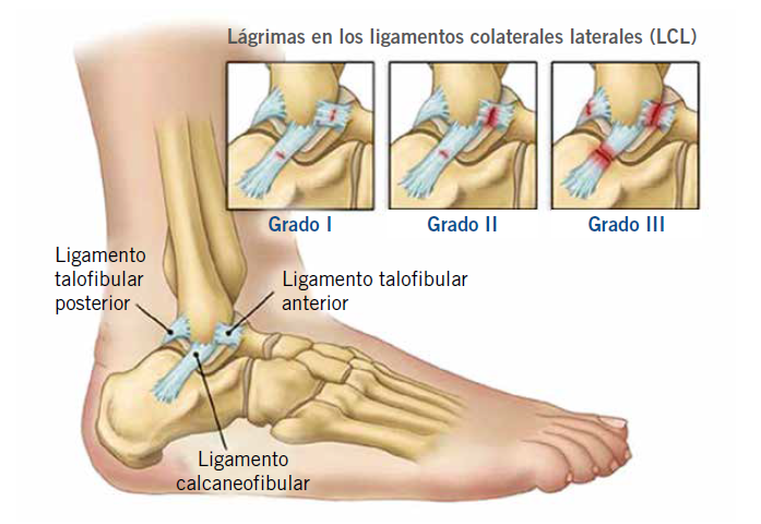 Calzar habitualmente botas de fútbol sala puede afectar a los pies de los  niños