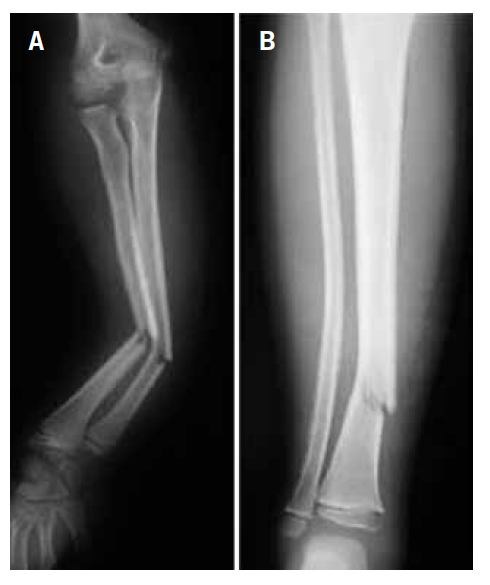 Bibliografía Materialismo Regulación Fracturas infantiles más frecuentes. Esguinces y epifisiolisis | Pediatría  integral