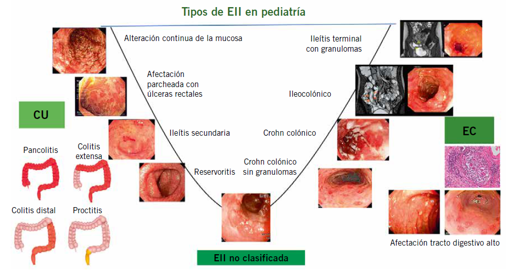 Extraen 61 bolas magnéticas del intestino de un niño, tenía fuerte dolor de  estómago