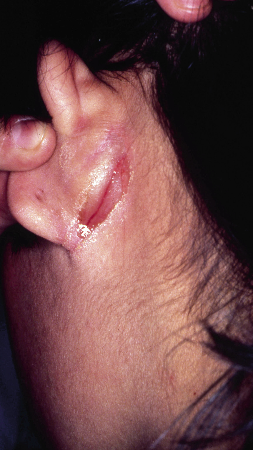 Dermatitis atópica y dermatitis seborreica