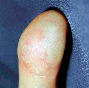 Infecciones cutáneas de etiología vírica | Pediatría integral Infecciones cutáneas de etiología vírica | Pediatría integral