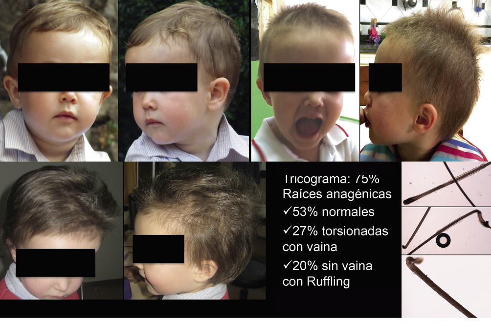 Alteraciones más frecuentes del pelo en Pediatría - G.M. Garnacho Saucedo, J.C. Moreno Giménez 