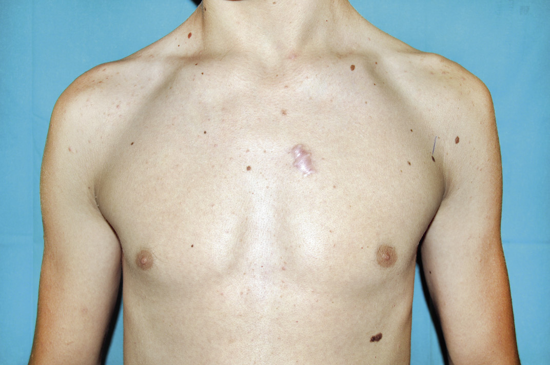 Trastornos de la pigmentación: lentigos, nevus y melanoma. Fotoprotección - J. Anderson Vildósola, A. Hernández Martín 