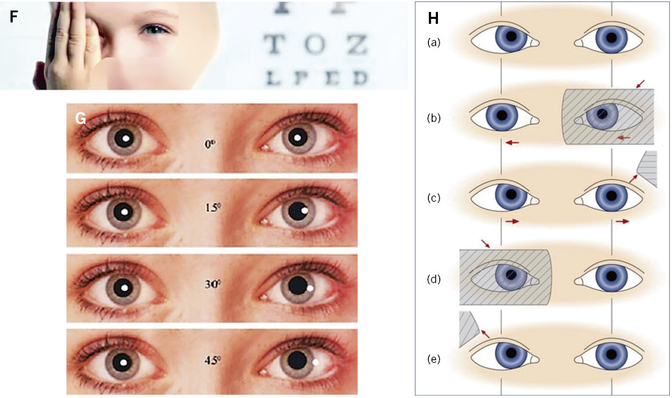 El cigarrillo y las enfermedades oculares - American Academy of  Ophthalmology